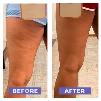 Anti-Cellulite Massager