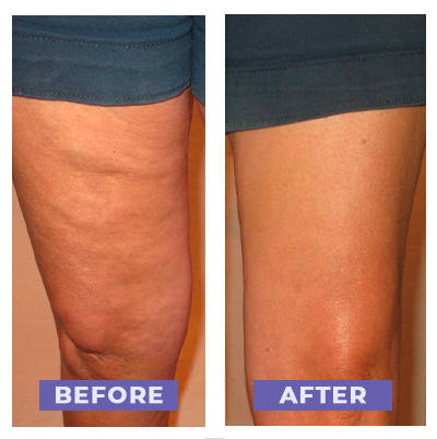 Anti-Cellulite Massager